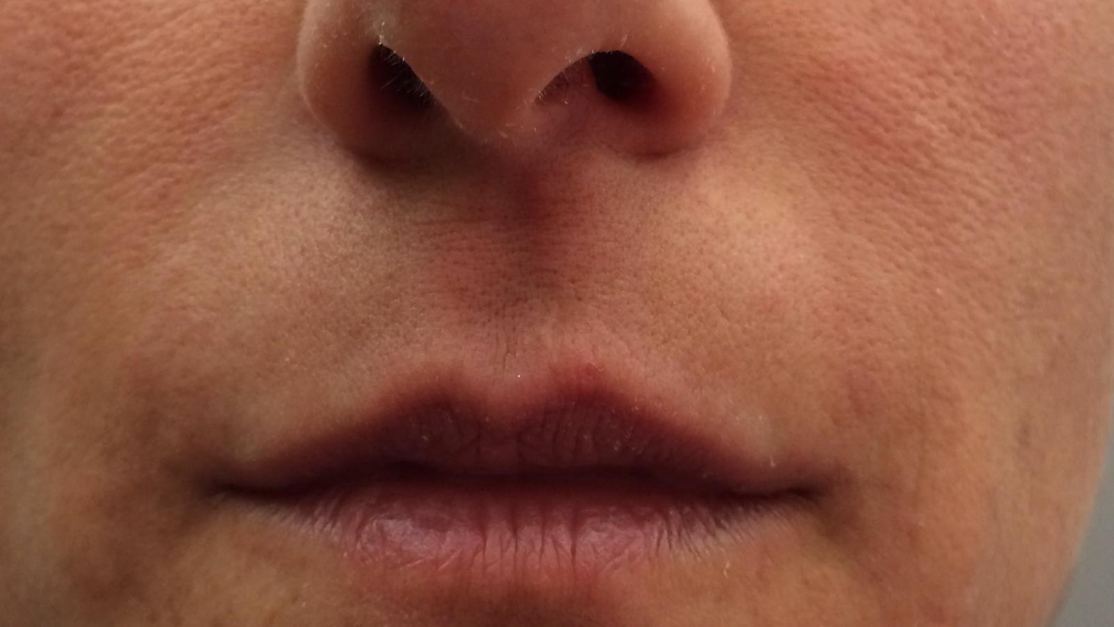 RELLENO DE ARRUGAS - DESPUÉS